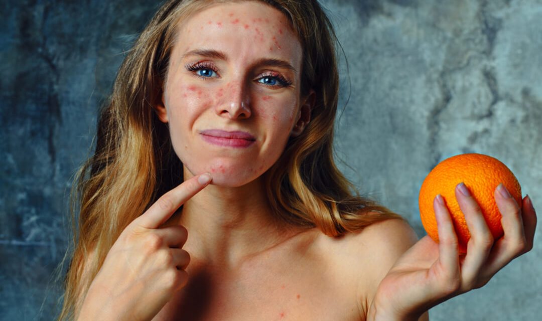 Say Goodbye to Acne Forever by Changing What You Eat