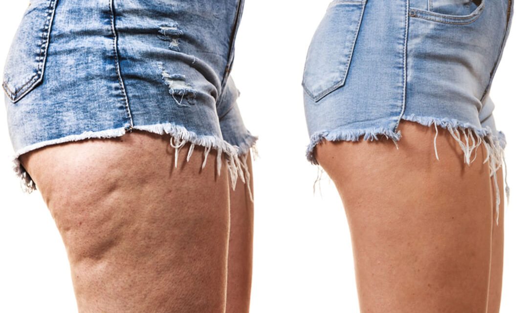 The Best Cellulite Treatments and Best Ways To Get Rid Of Cellulitis Fast