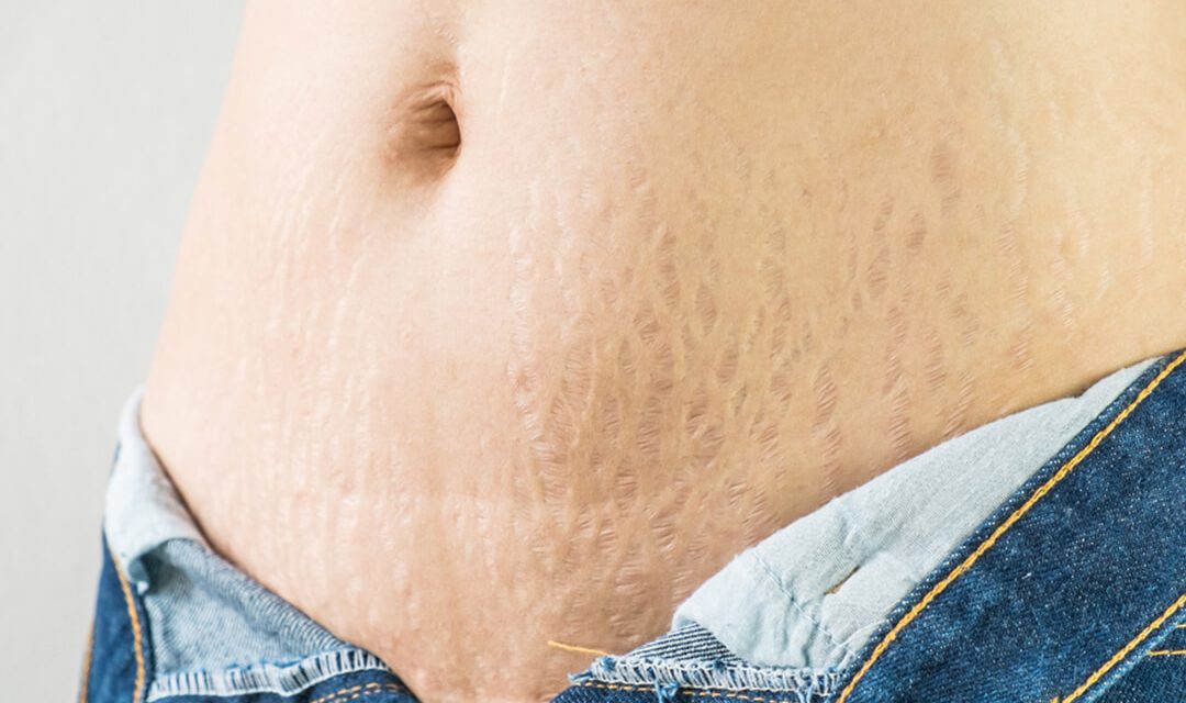 9 methods of Stretch Mark Removal – Natural, Medical, Surgical Treatments